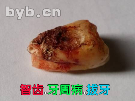 byb.cn 智齒.牙周病.拔牙