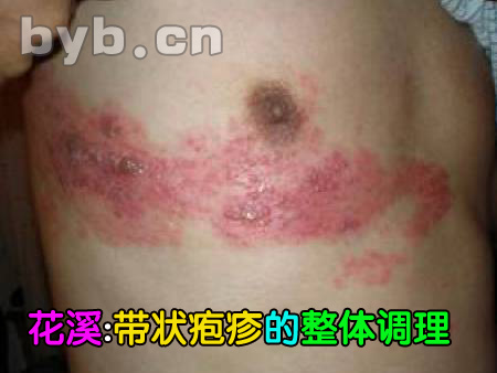 byb.cn 帶狀皰疹