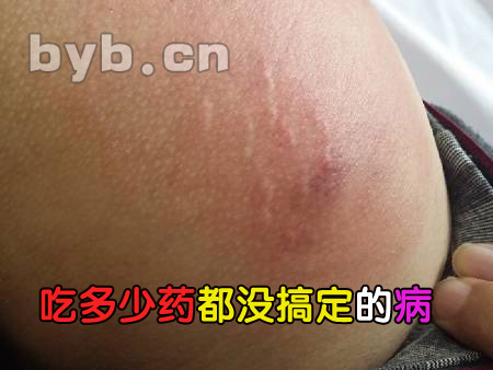 byb.cn 吃多少藥都沒(méi)搞定的病